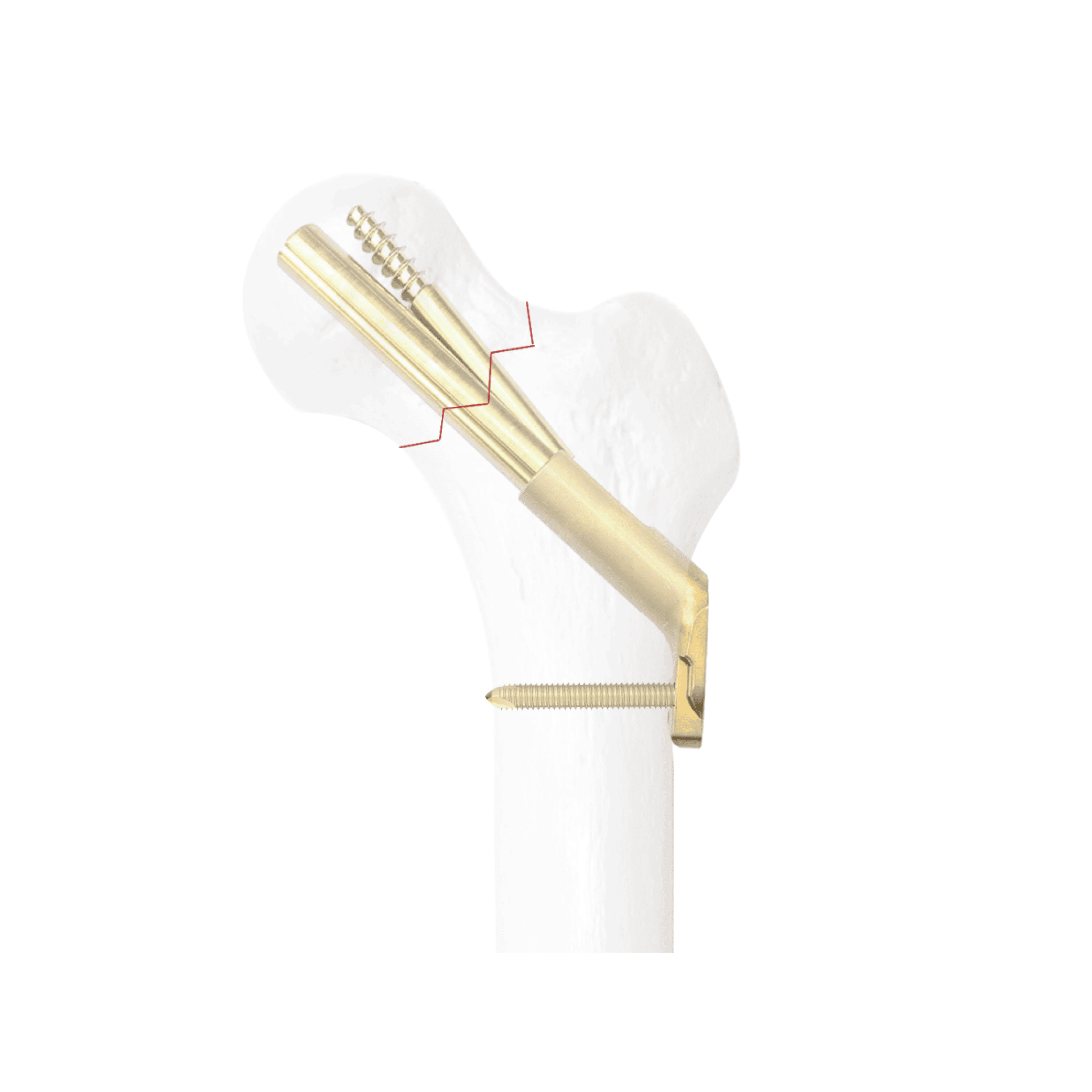 LCC Locking Composite Pressure Connecting System