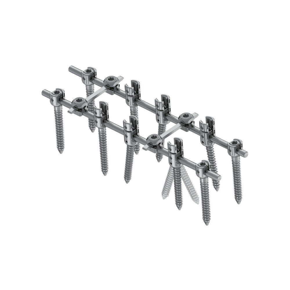 KSS-II 5.5 Spinal Fixation System - Posterior Fixation