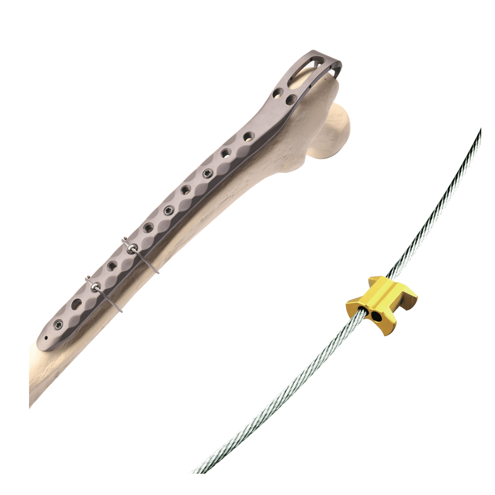 Titanium Cable Fixation System (Sterile Packaging)